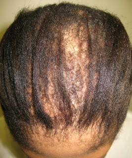 Central Cetrifugal Cicatrical Alopecia
