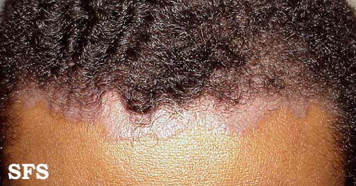 seborrheic dermatitis face african american