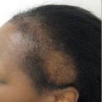 Black woman showing missing parts of hair