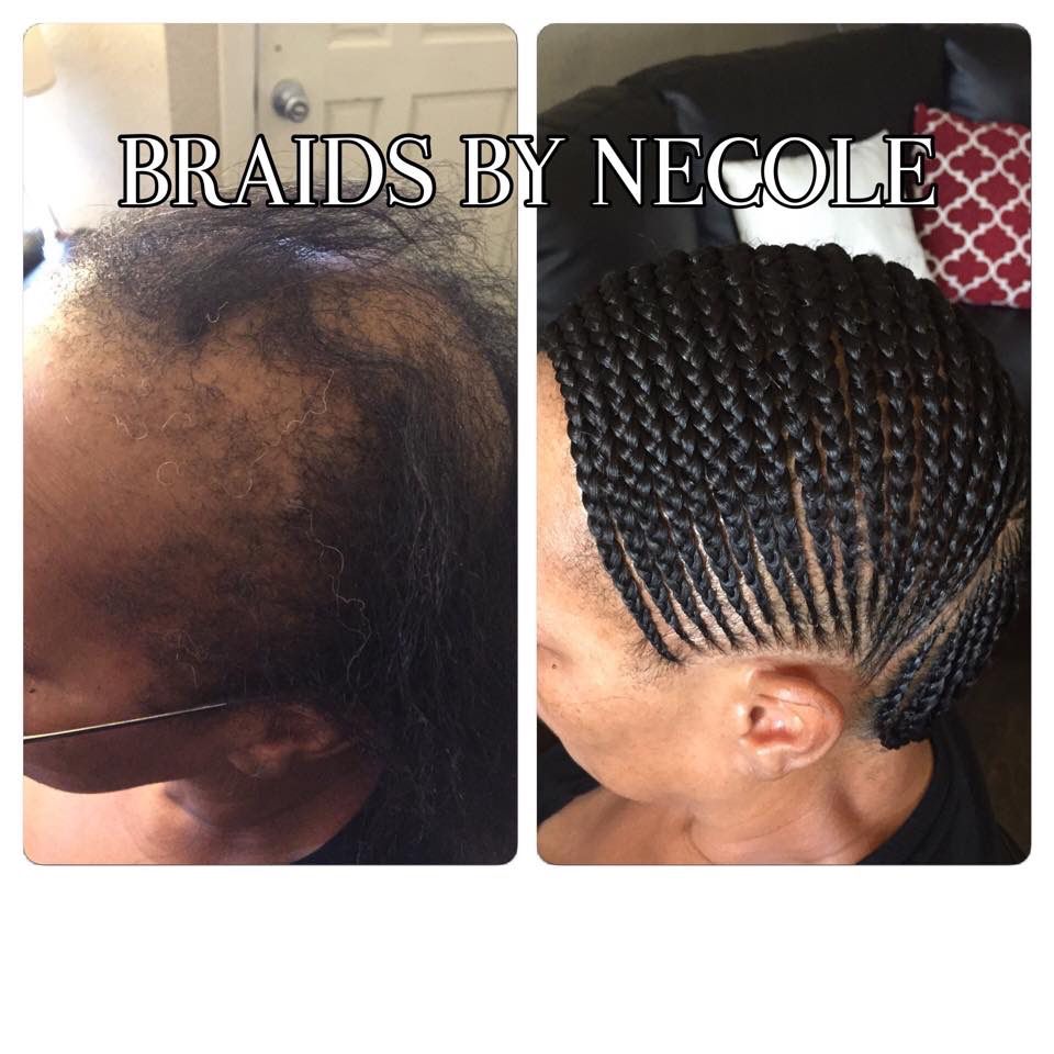 14 Extraordinary Alopecia Camouflage Cornrows By Braids By Necole