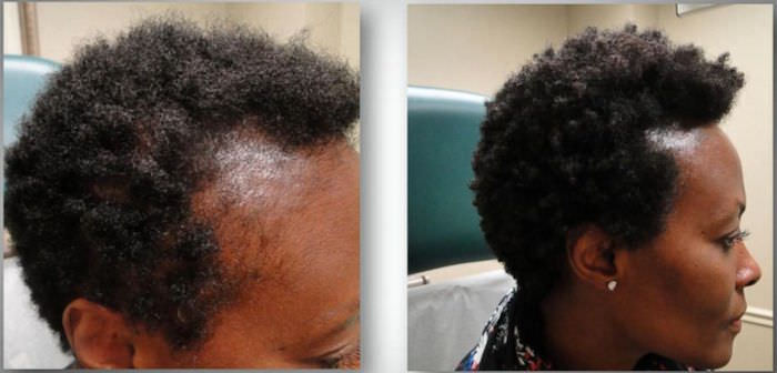 keratin treatment black women